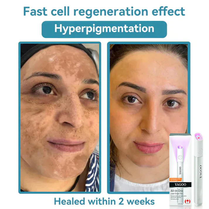 Yagoo™Canada latest All-in-One CO₂ Laser Eraser Pen | Removes Moles, Warts, Skin Flaws & Pigmentation